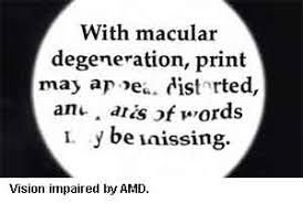 Macular Degeneration F