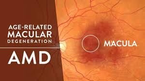 Macular Degeneration G