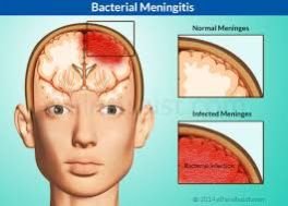 MENINGITIS - D