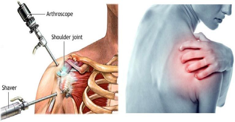 Yoga Treatment for Frozen Shoulder 01
