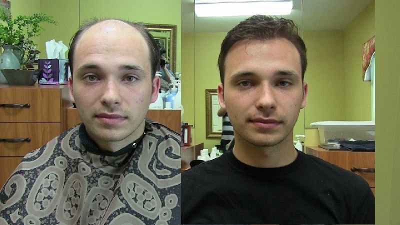 Mens Hair Patch Services 01