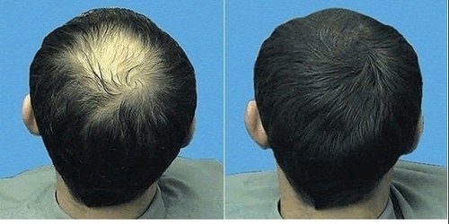 Mens Hair Patch Services 02