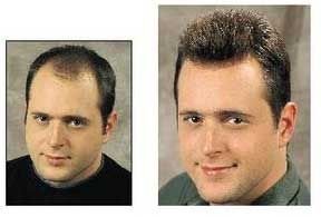 Mens Hair Weaving Services 01