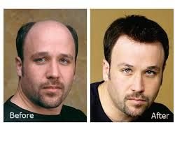 Mens Non Surgical Hair Replacement  Services 02