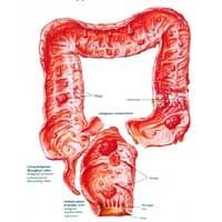 Familial Polyposis