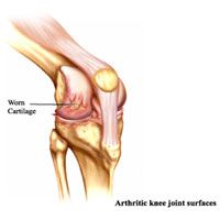 Arthritis and Joint Pains