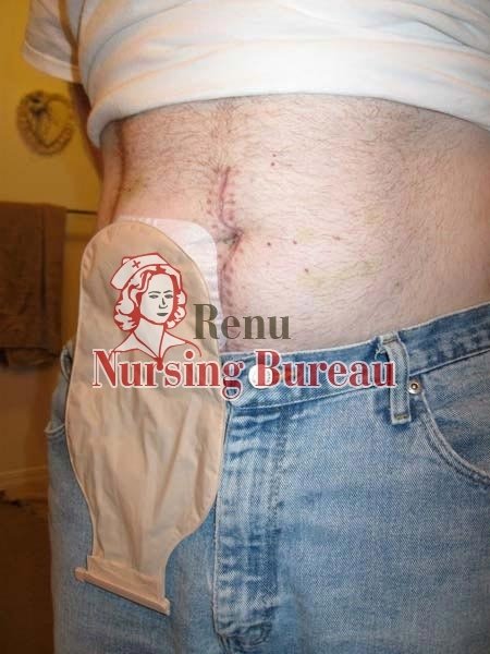 Colostomy Bag