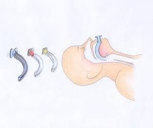 Airway Tube