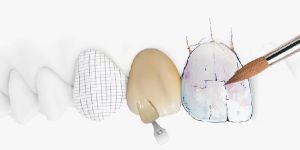 Digital Crown & Bridges