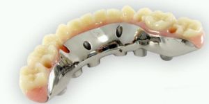 Dental Implant Hybrid Restorations