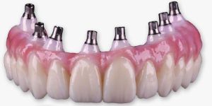 Dental Implants