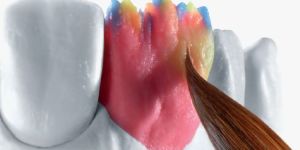 IPS e.max Ceramic Restorations