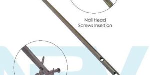 Hyper Tibial Interlocking Nail