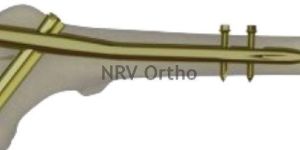 Long Proximal Femoral Nail