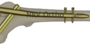 Short Proximal Femoral Nail