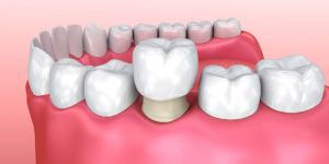 Dental Crown Fixing Services