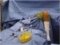 Disposable THR KIT ( Total Hip Replacement Kit )