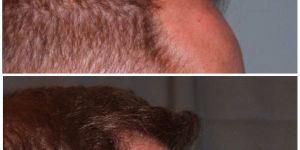 Hair Transplantation