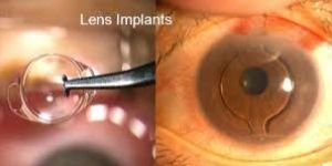 Optical Eye Lens