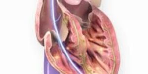 Implantable Cardioverter Defibrillators