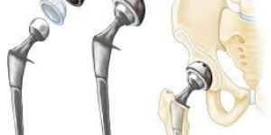 Artificial Hip Joints