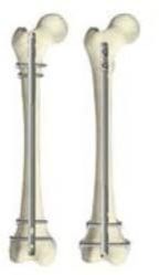 Femur Nail