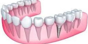 Dental Implants