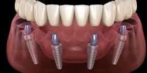 Dental Implants