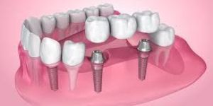 Dental Implants
