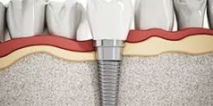 Dental Implants