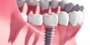 Dental Implants