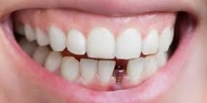 Dental Implants