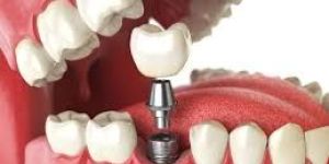 Dental Implants