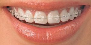 Ceramic Braces Services