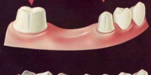 Dental Bridge Treatment Services