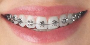 Metal Braces Treatment Services