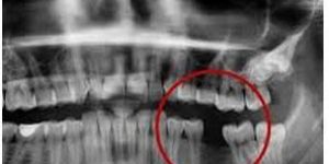 X-ray viewing screen