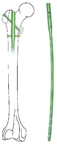 Femoral Bone Classic Interlocking Nail