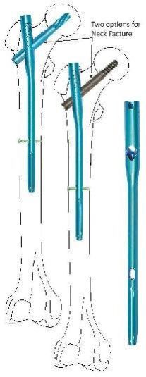 Femoral Bone Hyper Proximal Interlocking Nail