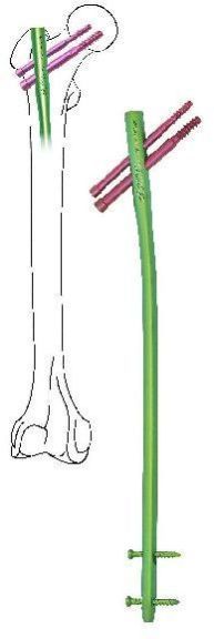 Femoral Bone Long Proximal Interlocking Nail