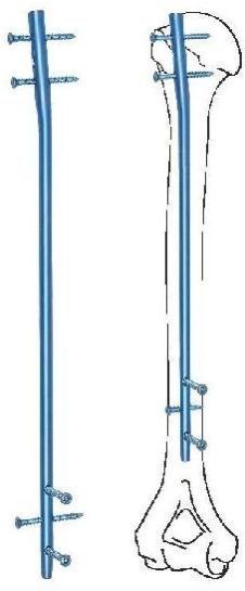 Humeral Bone Classic Interlocking Nail