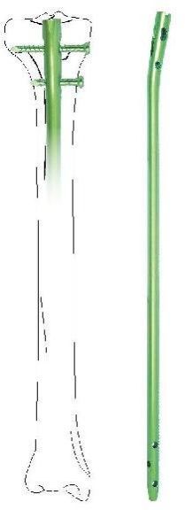 Tibial Bone Classic Interlocking Nail