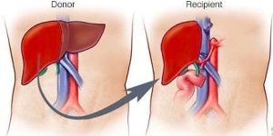 Liver Transplant Service