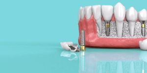 Dental Implant Services