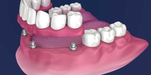 Overdenture Treatment Services