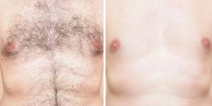 Laser Hair Removal in Janakpuri, Dwarka