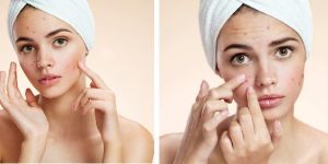 Acne Treatment Services
