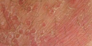 Fungal Infection Treatment