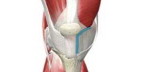 Minimally Invasive Total Knee Replacement Surgery
