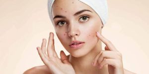 Acne Scars Treatment